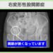 右変形性股関節症（臼蓋形成不全）　幹細胞治療