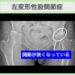 左変形性股関節症(臼蓋形成不全、臼蓋骨嚢胞) 幹細胞治療