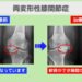 両変形性膝関節症