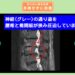 腰椎脊柱管狭窄症