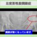 変形性股関節症
