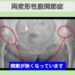 変形性股関節症