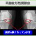両変形性膝関節症