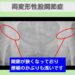 変形性股関節症