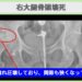 大腿骨頭壊死