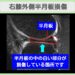 半月板損傷