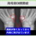 両母指CM関節症