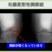 変形性膝関節症