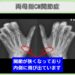 CM関節症