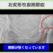 左変形性股関節症