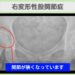 右変形性股関節症