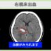 右視床出血