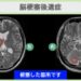 脳梗塞後遺症