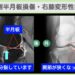 右膝外側半月板損傷・右膝変形性関節症