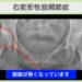 右変形性股関節症 50代女性のレントゲン所見
