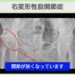 股関節(OA)の症例 大阪院-600