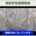 股関節(OA), 膝（OA）の症例 大阪院-685