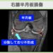 右膝半月板損傷