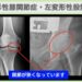 右変形性膝関節症・左変形性股関節症のレントゲン画像