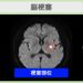 脳梗塞のMRI所見