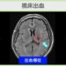 視床出血