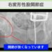 右変形性股関節症のレントゲン所見