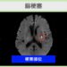 脳梗塞のMRI所見